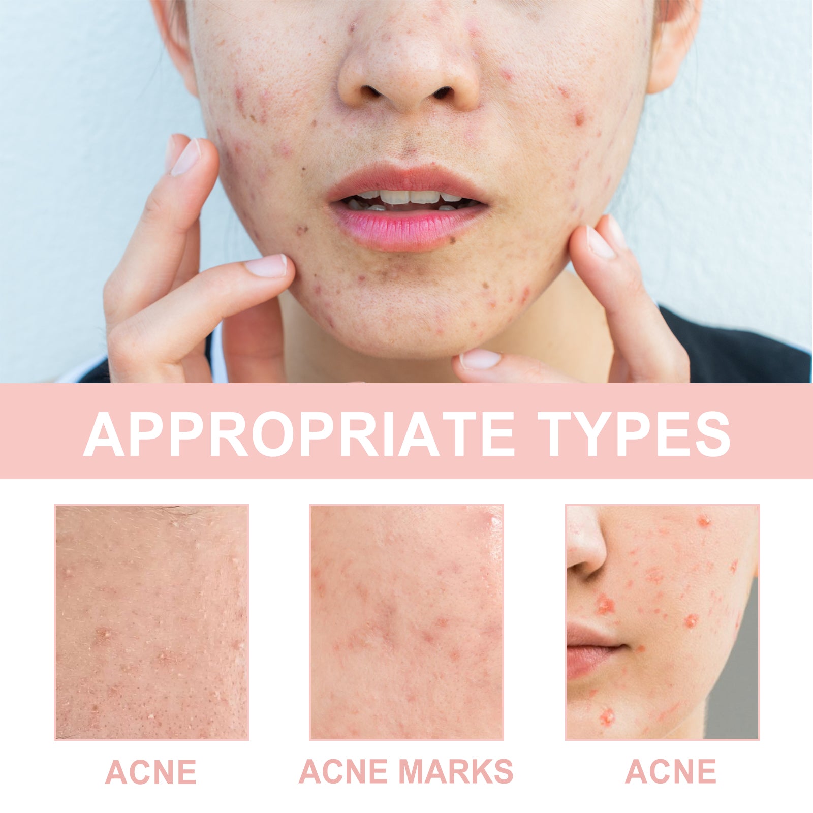 Acne Patch — Pore Cleansing, Blemish Repair & Moisturizing